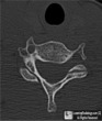Unliateral Locked Facet